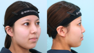 『フェイスラインを鮮明に。小顔の王道『頬・顎下脂肪吸引』』の画像