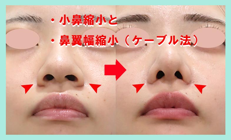 『貴族手術をすると、小鼻が広がります。その防止手術を同時に行うことで、悩みはなくなります。』の画像