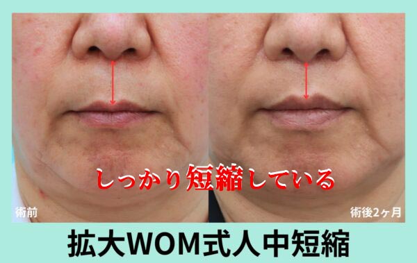 拡大人中短縮術術前術後