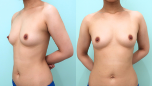 『2度目の豊胸?希望を叶えるシリコン豊胸!』の画像