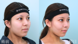 『フェイスラインを鮮明に。小顔の王道『頬・顎下脂肪吸引』』の画像