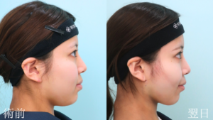 『フェイスラインを鮮明に。小顔の王道『頬・顎下脂肪吸引』』の画像