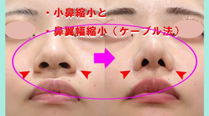 貴族手術副作用対策