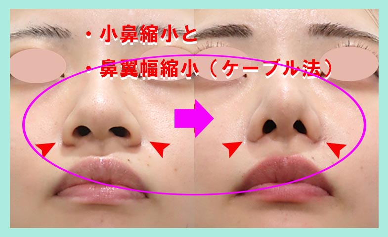 貴族手術副作用対策