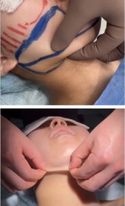 『フェイスラインを鮮明に。小顔の王道『頬・顎下脂肪吸引』』の画像