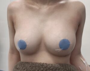 『2度目の豊胸?希望を叶えるシリコン豊胸!』の画像