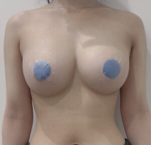 『2度目の豊胸?希望を叶えるシリコン豊胸!』の画像