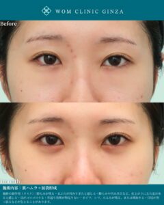 『涙袋形成の症例が豊富な理由|安定した仕上がりを生む技術とは』の画像