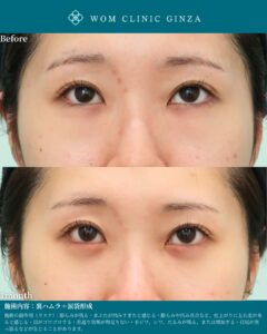 『涙袋形成の症例が豊富な理由|安定した仕上がりを生む技術とは』の画像