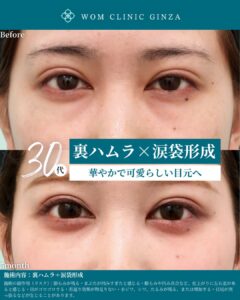 『裏ハムラ+涙袋形成の術後5か月経過|長期安定性で見る完成度の高い目元形成』の画像