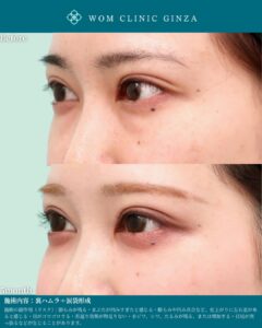『裏ハムラ+涙袋形成の術後5か月経過|長期安定性で見る完成度の高い目元形成』の画像