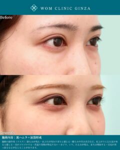 『裏ハムラ+涙袋形成の術後5か月経過|長期安定性で見る完成度の高い目元形成』の画像