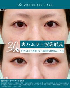 『世界で評価される裏ハムラと涙袋形成｜海外医師が認めた技術力とは』の画像