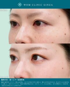 『世界で評価される裏ハムラと涙袋形成｜海外医師が認めた技術力とは』の画像