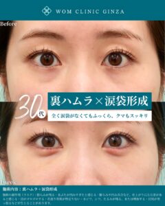 『裏ハムラと涙袋形成でダウンタイムを最小限に|術後1週間で見る』の画像