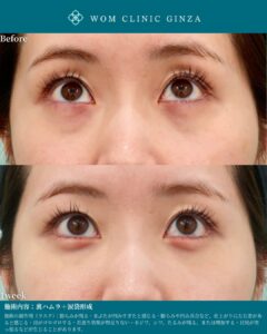 『裏ハムラと涙袋形成でダウンタイムを最小限に|術後1週間で見る』の画像