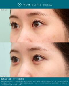 『裏ハムラと涙袋形成でダウンタイムを最小限に|術後1週間で見る』の画像