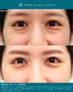 『涙袋形成で可愛く!似合うデザインと幅を見極める目元形成術』の画像