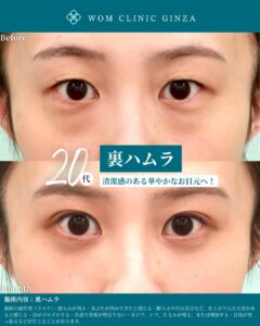 『裏ハムラで自然に綺麗に仕上げる鍵は剥離｜“ハムラ顔”を避ける考え方』の画像