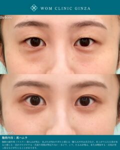 『裏ハムラで自然に綺麗に仕上げる鍵は剥離｜“ハムラ顔”を避ける考え方』の画像