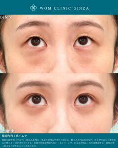 『裏ハムラで自然に綺麗に仕上げる鍵は剥離｜“ハムラ顔”を避ける考え方』の画像