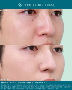 『ポニーテールリフトで男性もイケメン化｜切らないフェイスリフトという選択』の画像