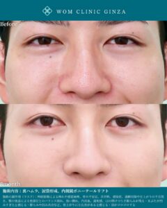 『ポニーテールリフトで男性もイケメン化｜切らないフェイスリフトという選択』の画像