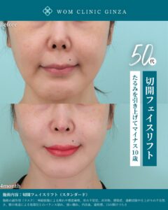 『フェイスリフトは種類選びがすべて｜切開から内視鏡まで対応する理由』の画像
