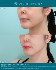 『フェイスリフトは種類選びがすべて｜切開から内視鏡まで対応する理由』の画像