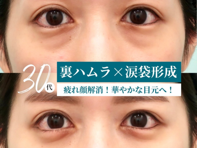 裏ハムラ、涙袋形成