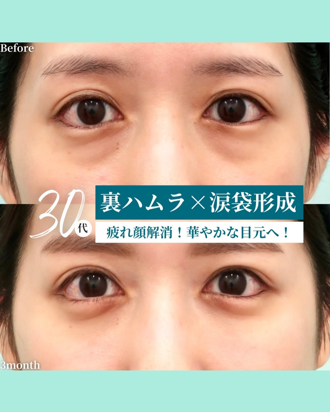 裏ハムラ、涙袋形成