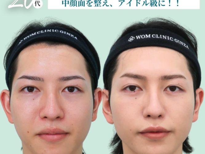 ポニーテールリフト