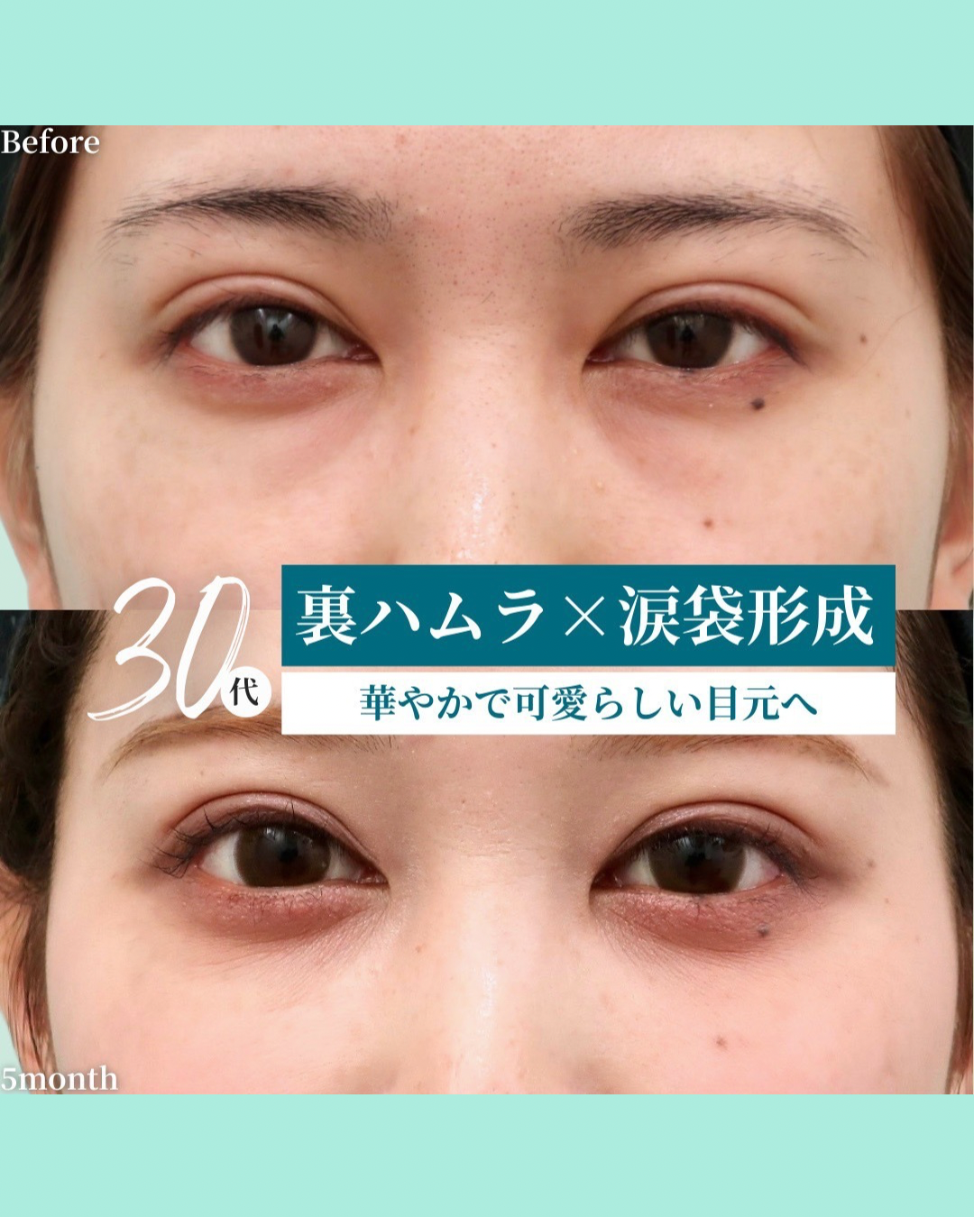 裏ハムラ、涙袋形成