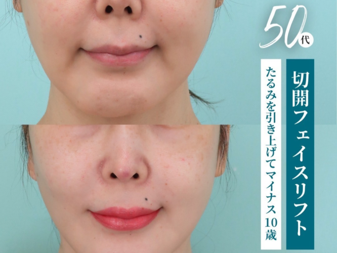 切開フェイスリフト
