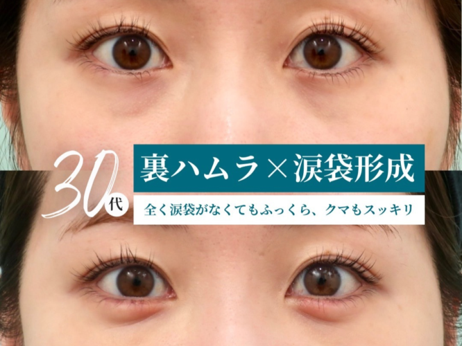 裏ハムラ、涙袋形成