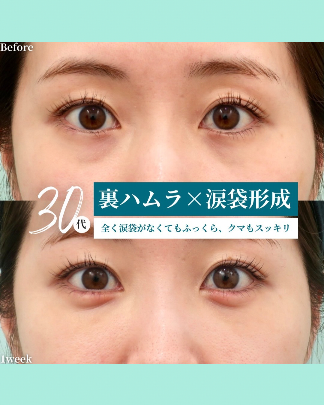 裏ハムラ、涙袋形成