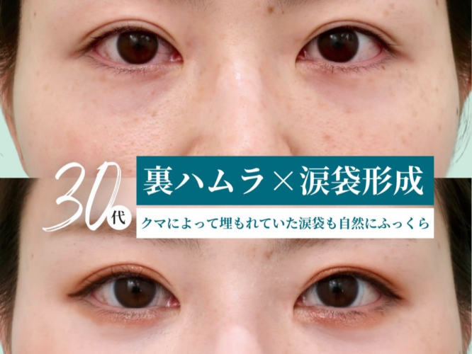 裏ハムラ、涙袋形成