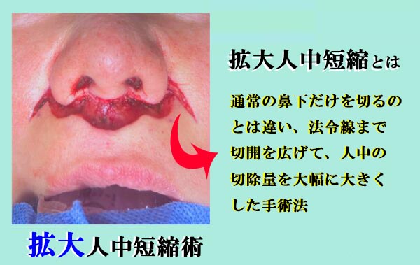 拡大人中短縮術