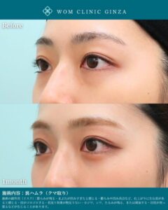 目元の施術前と施術1ヶ月後の比較