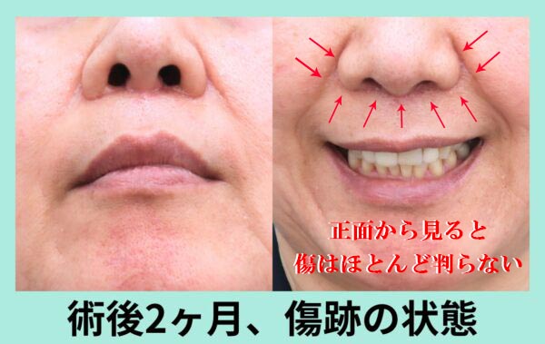 『「拡大」人中短縮術：鼻下の大幅切除が可能なWOM式の人中短縮法の解説！｜』の画像