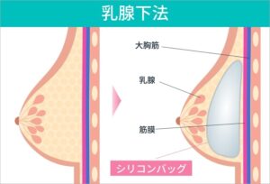 乳腺下法による豊胸手術の比較図