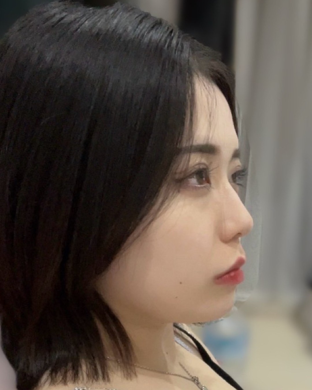 骨切り×WOM式小顔術 BEFORE写真