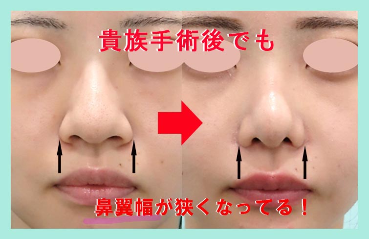 『貴族手術をすると、小鼻が広がります。その防止手術を同時に行うことで、悩みはなくなります。』の画像