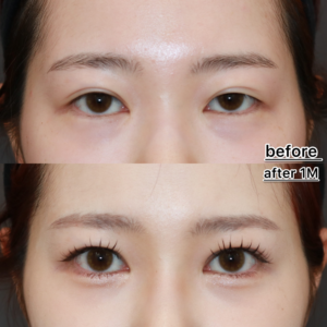二重整形の他院修正ビフォーアフター