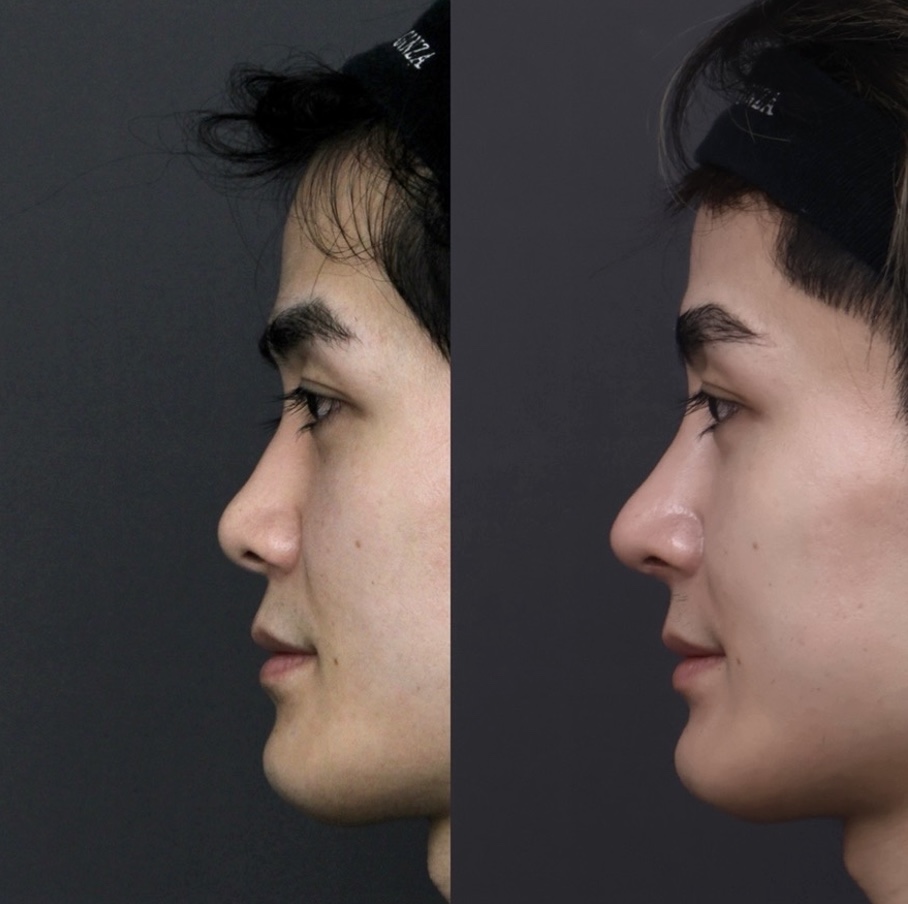 『【男性らしい鼻とは何か?】 初回鼻整形でつくる“かっこいい”の本質』の画像