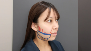 『フェイスラインを鮮明に。小顔の王道『頬・顎下脂肪吸引』』の画像