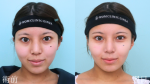 『フェイスラインを鮮明に。小顔の王道『頬・顎下脂肪吸引』』の画像