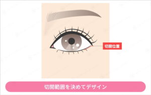 目元拡大図と切開位置を示すイラスト