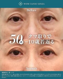 目元のクマ取り整形前後写真50代女性