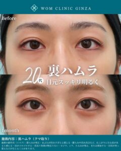 施術前後目の比較20代女性